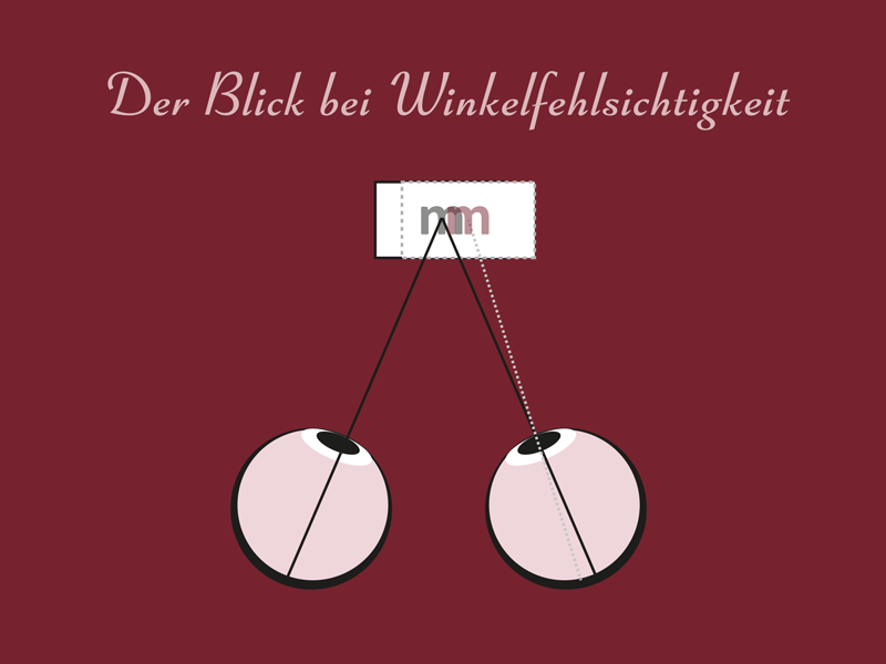 Winkelfehlsichtigkeit Messung Winkelfehlsichtigkeit Messung